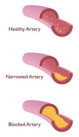 Artery Disease Spring Hill Disability Benefits